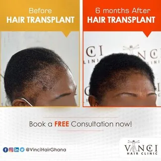 Vinci hair transplant before and after